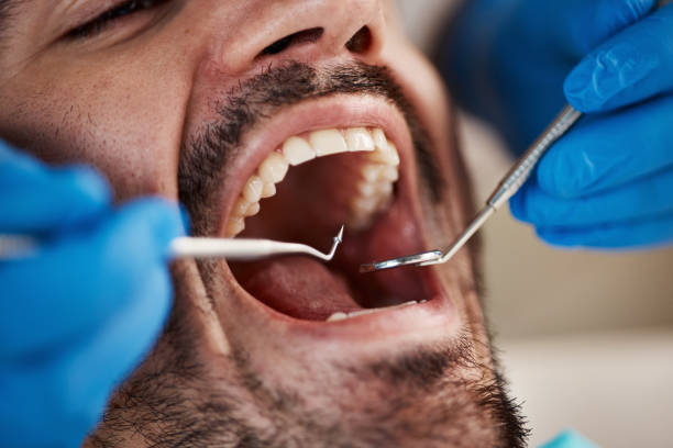 Best Broken or Chipped Tooth Repair in Westgate, FL